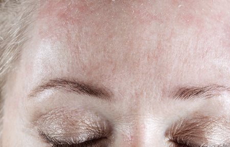 Šupinatá pleť na čele ženy
